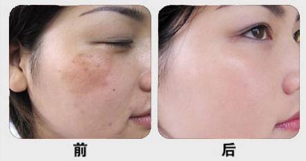 长斑祛痘最好的护肤品,长斑长痘的适合什么护肤品