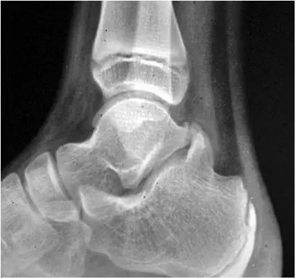 踝关节撞击症问诊,踝关节撞击综合征的x线表现