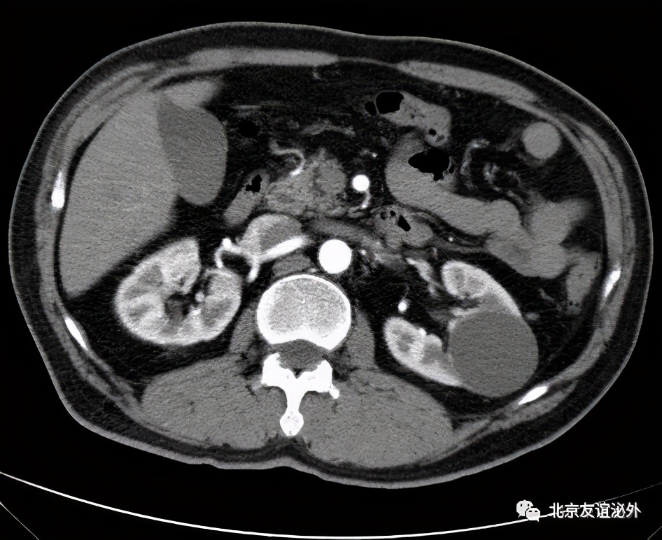 体检发现肾囊肿了怎么办?