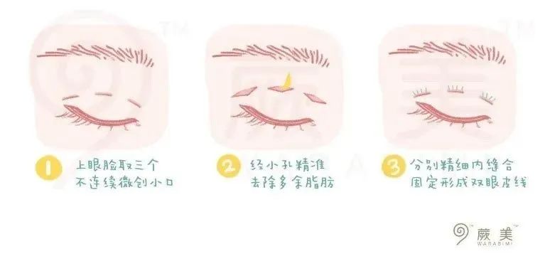 到底该不该全切双眼皮,怎么判断自己该不该割双眼皮