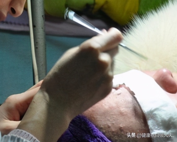 当针清碰上淋雨：陕西21岁女子为了相亲清闭口，却养出来白癜风