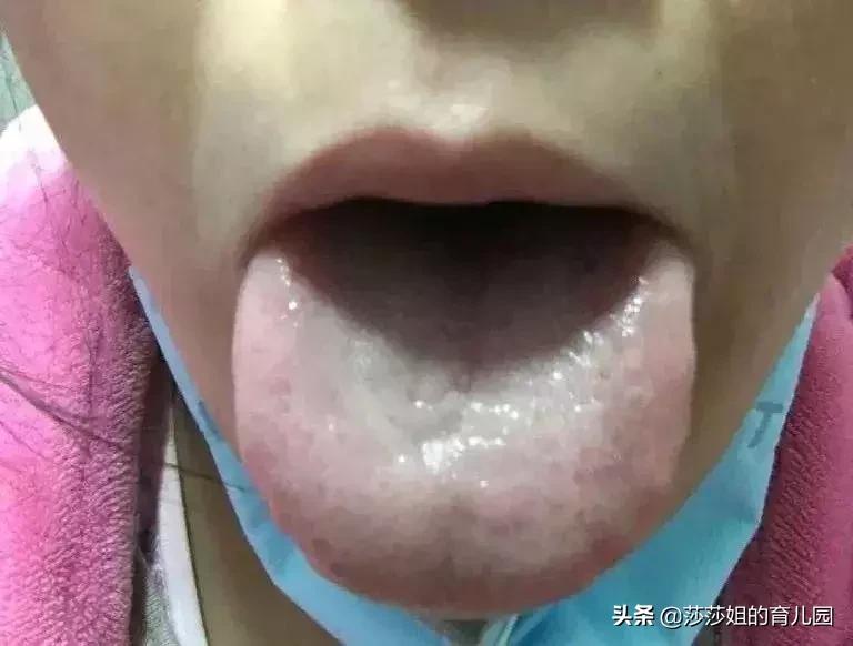 小朋友增强细菌免疫力的药,儿童打抗生素后如何恢复抵抗力