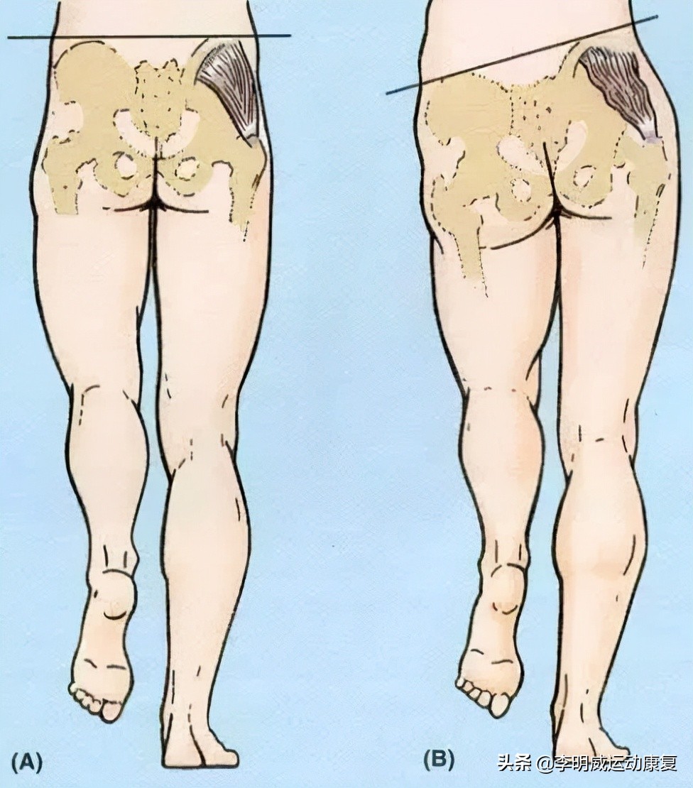 骨盆前倾骨盆不正怎么恢复,骨盆不正会造成什么后果