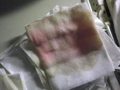 脂肪液化伤口不愈合需要注意什么,伤口液化不愈合会一直液化吗