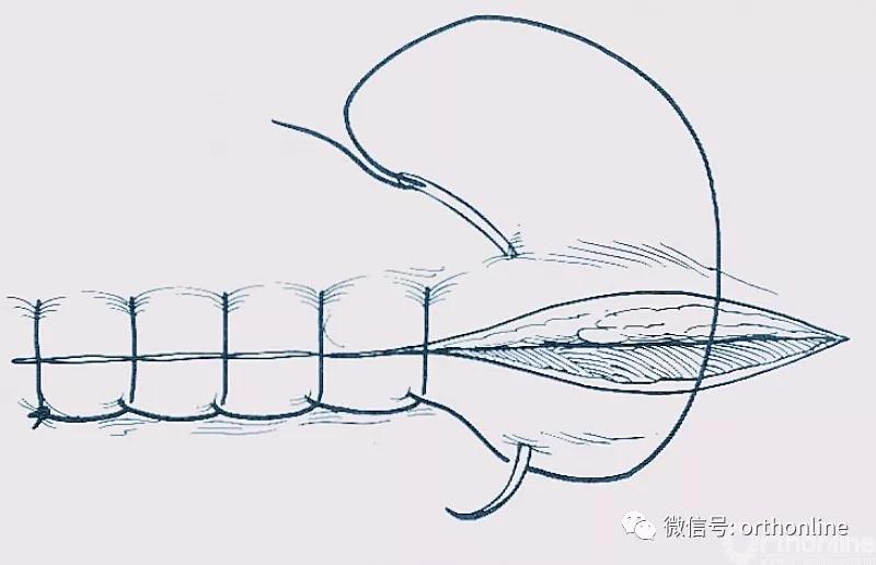 常用的手术缝合方法图,临床常见常用伤口缝合方法