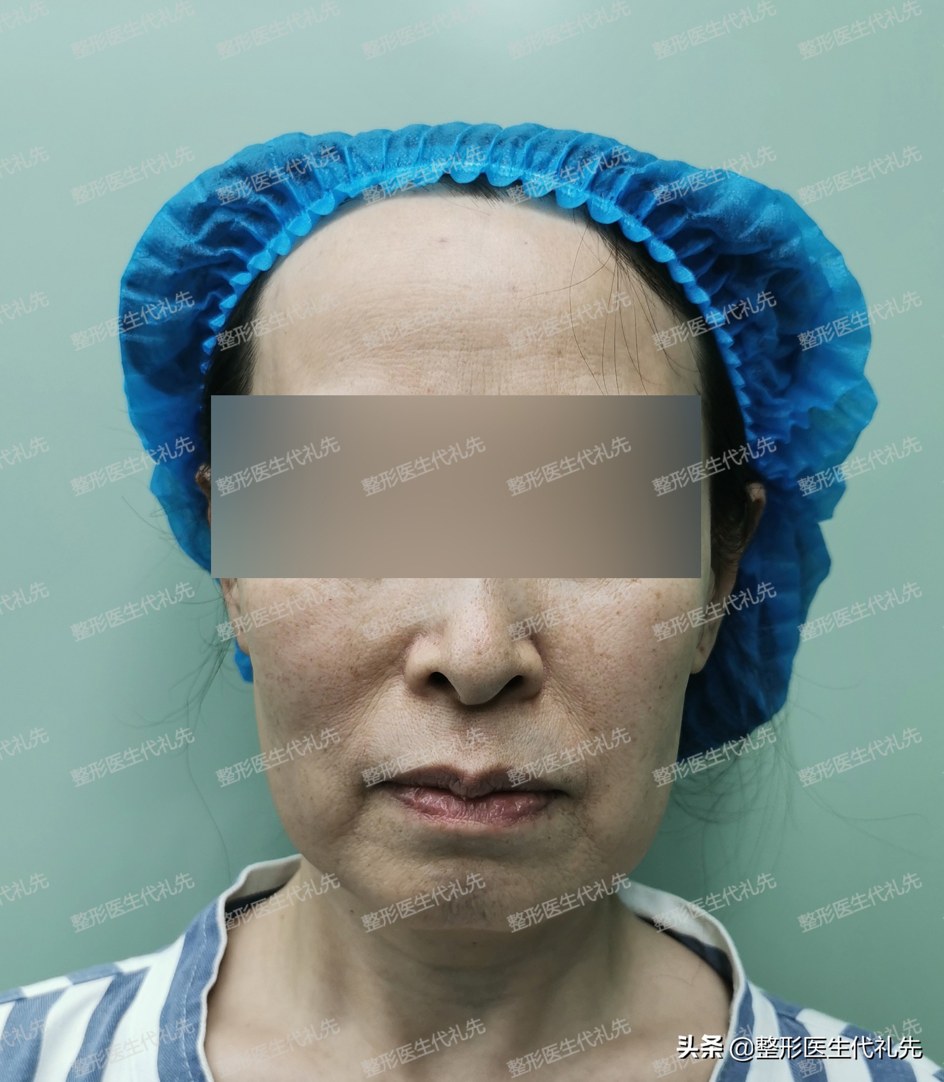 拉皮手术能彻底去除法令纹吗,拉皮术后法令纹木偶纹还在怎么办