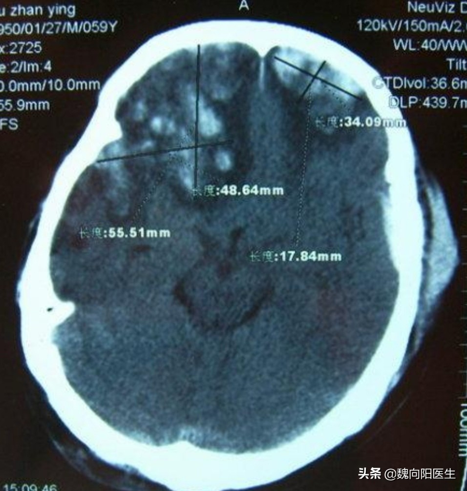 后脑勺着地可能出现什么症状,后脑勺着地算什么伤