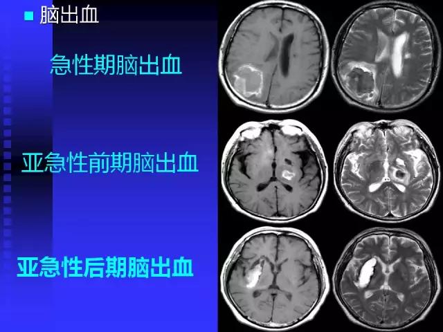 头颅mri读片视频教程,颅脑mri读片入门教程视频讲解全集