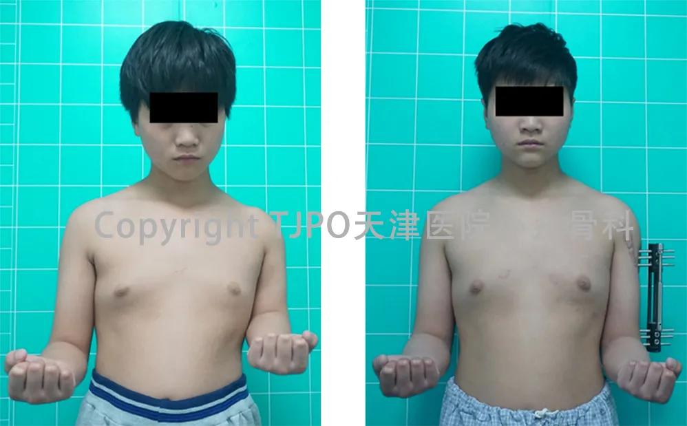 小儿骨科矫正足内翻,宝宝足内翻矫形支具