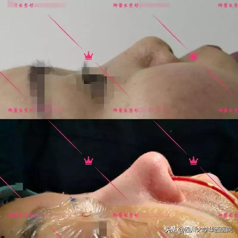 鼻子太翘怎么整形,鼻子太尖整形修复最佳方法