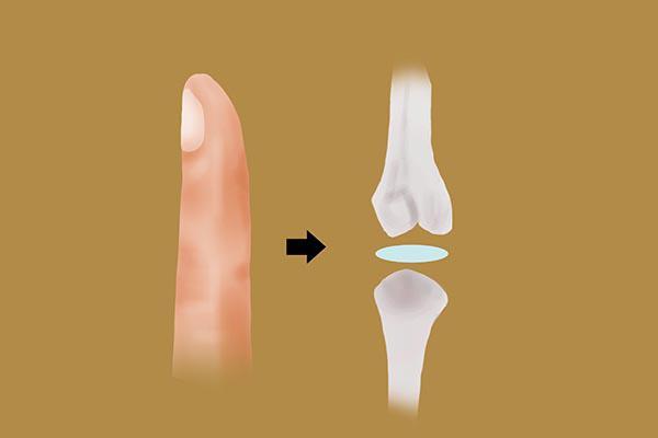 每次膝盖蹲下会咔咔的声音,蹲下起来膝盖咔咔响怎么解决
