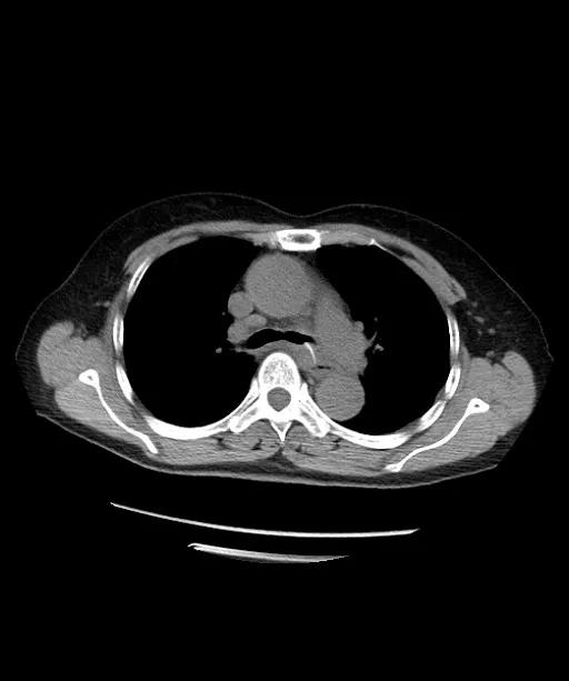 鱼刺卡住吞饭更严重示意图,鱼刺卡喉吃馒头咽下去了会怎样