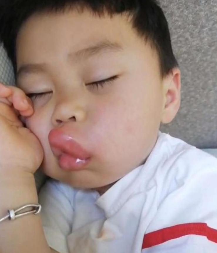 小孩嘴巴肿了一块,小孩嘴巴突然肿了