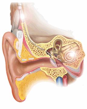 人工耳蜗移植术,人工耳蜗植入手术与听骨链修复术