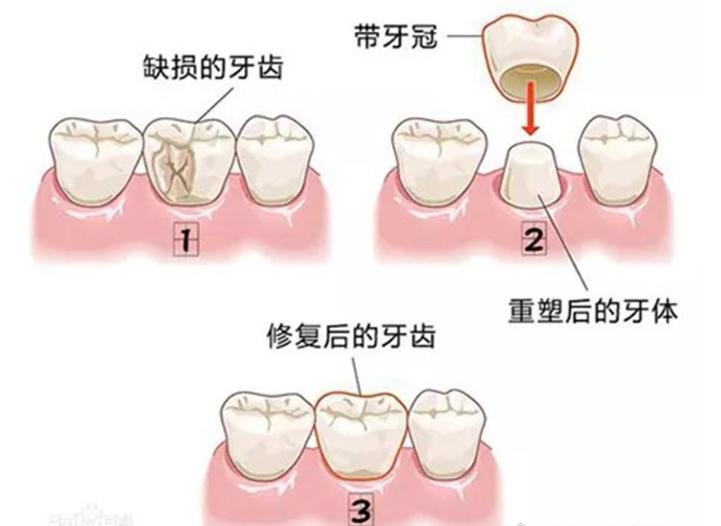烤瓷牙贴片全口价格,贴片牙齿和烤瓷牙有哪些伤害