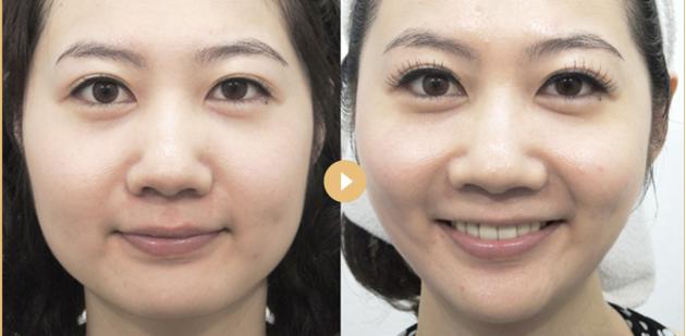 双下巴,嘟嘟肉,成年人的婴儿肥到底该肿么办?