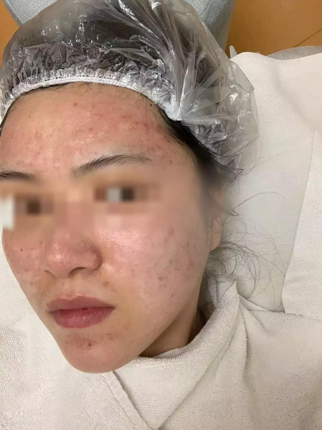 一次美容后她脸烂了!无锡这位女士在整形医院经历了什么……