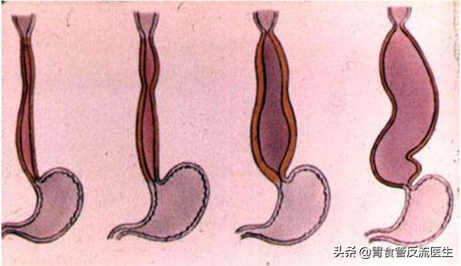 食管裂孔疝和贲门松弛哪个危害大,出现食管裂孔疝是怎么回事