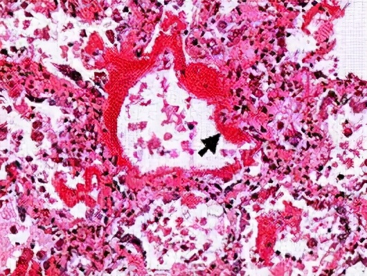 低镁血症猝死前兆,低镁血症对心肌的影响主要表现