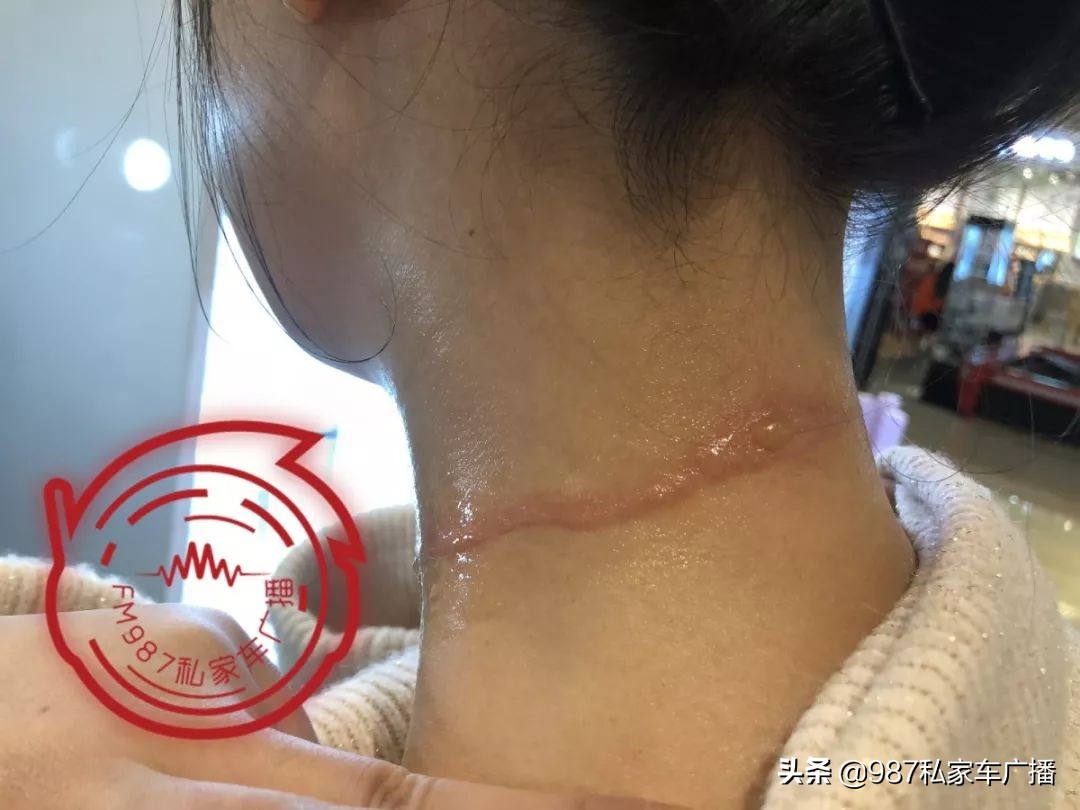 福州一女子进店美发,竟遭滚烫蒸汽喷射……疤痕吓人!