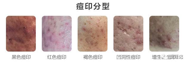 修复痘疤的药,修复痘疤痘坑用什么产品好