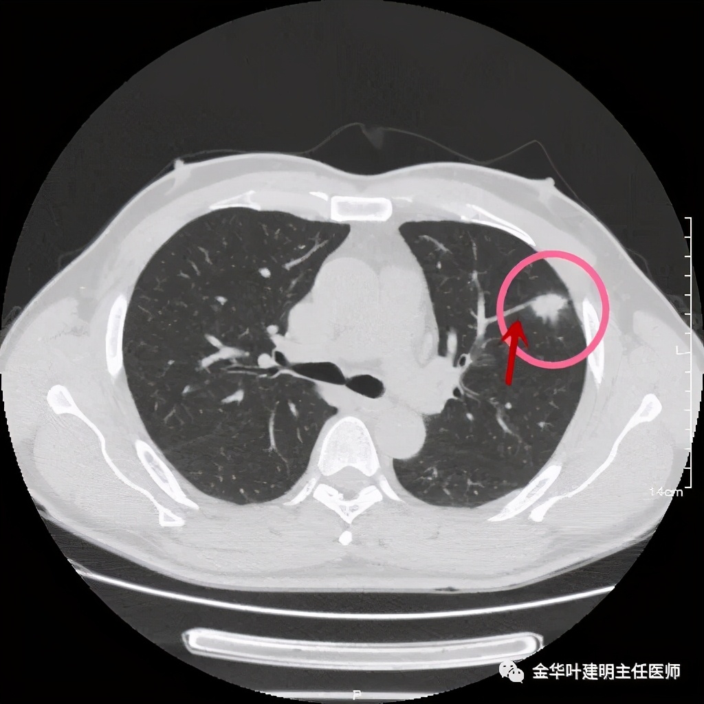 叶建明谈肺结节:一招分辨隐球菌性肉芽肿与肺癌