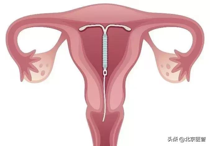 常见避孕方法优缺点比较,最好最安全的避孕方法有哪些