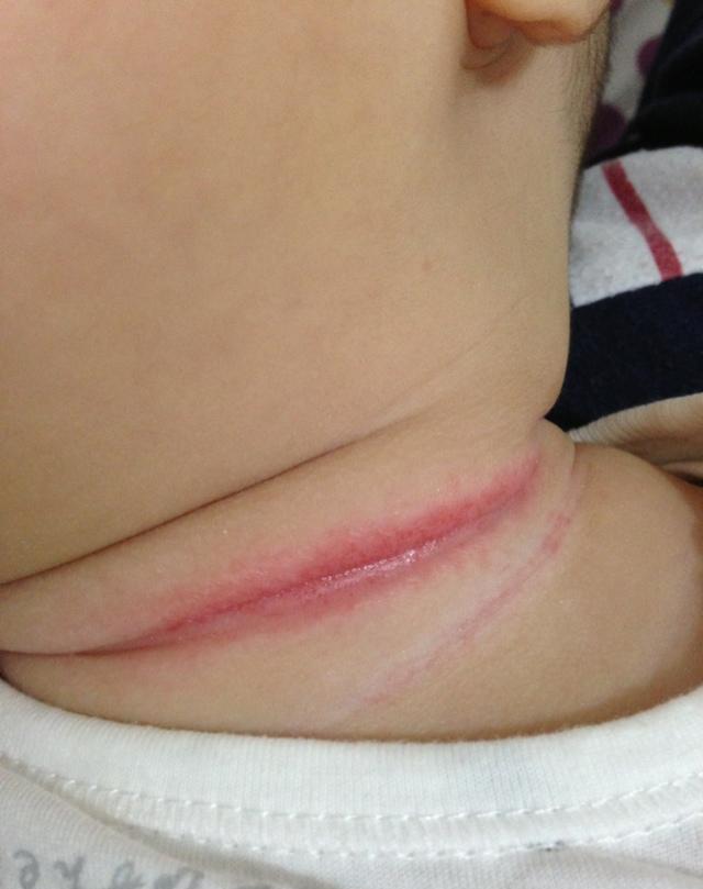 宝宝淹脖子的怎么处理,宝宝淹脖子了怎样护理