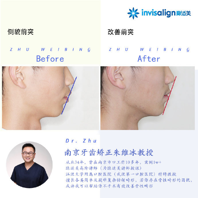 口腔正畸隐适美隐形矫治技术,隐适美深覆合矫正