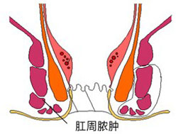 肛周脓肿健康宣教,肛周脓肿术后腹泻危害