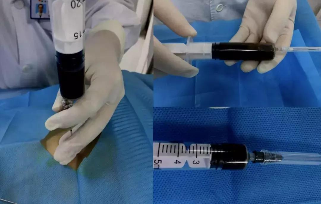 不明原因胸腔积液案例,胸腔积液病例