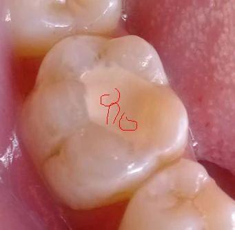 北大口腔医院儿童口腔科龋齿防治,哪家牙科医院治疗儿童龋齿好