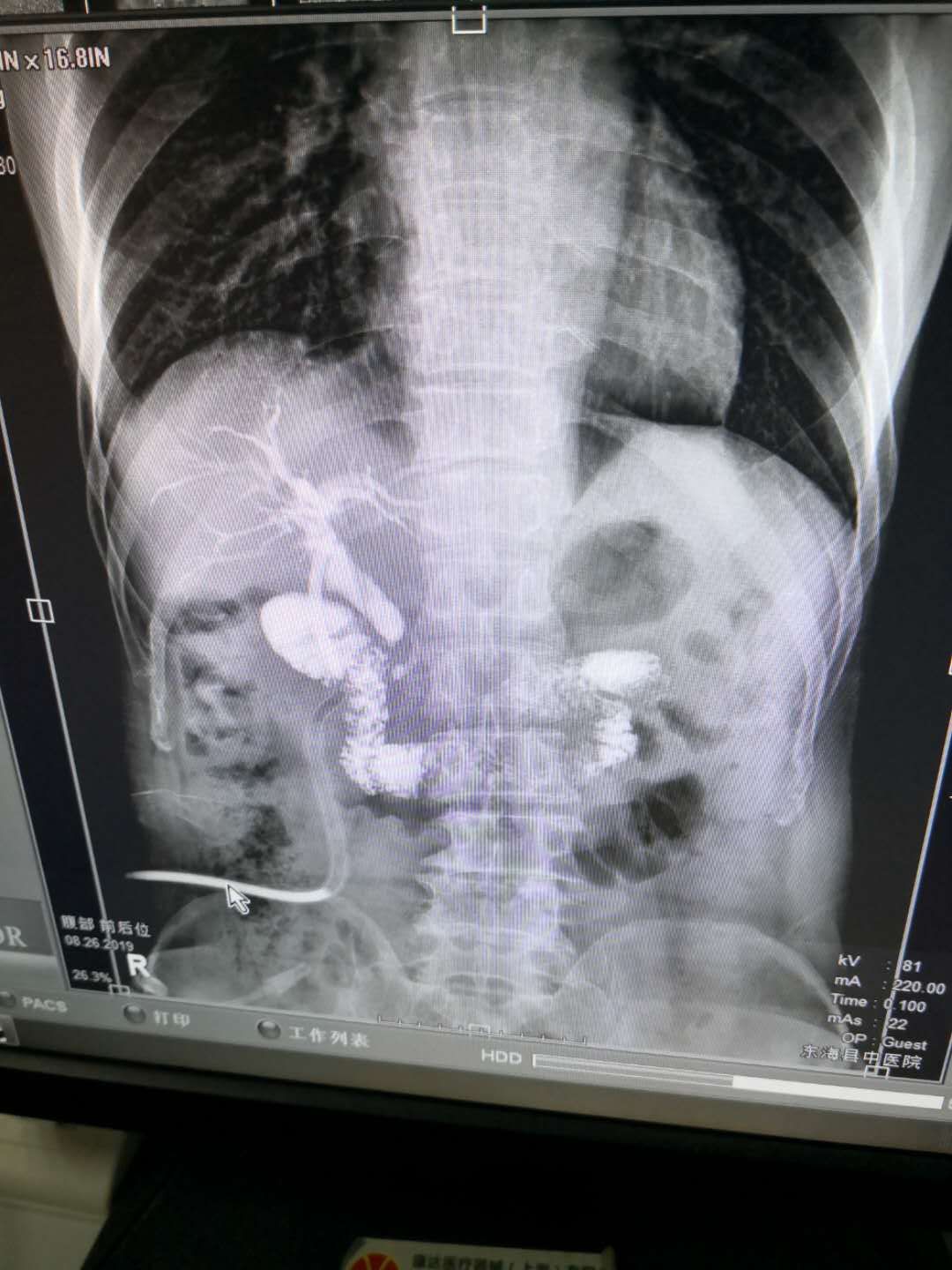 腹部手术完为什么要戴腹带,腹部手术之后为什么胀气