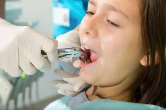 男子拔牙致死是什么原因,拔牙引起急性炎症