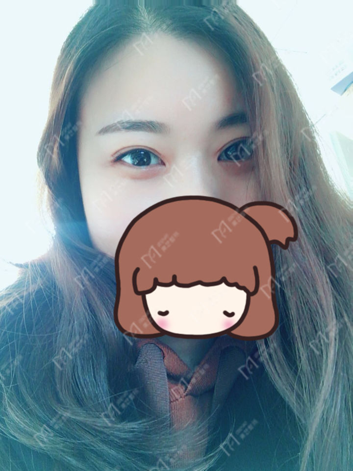 双眼皮割宽了怎么化妆,割双眼皮最宽能割几毫米