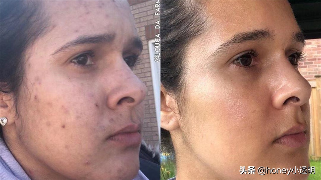 用粉刺针清理痘痘的步骤,用粉刺针清理粉刺