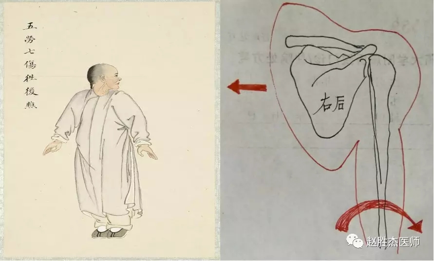 气功能治脊髓型颈椎病吗,气功导引法治疗颈椎病