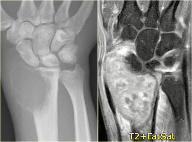 9种骶骨肿瘤,溶骨性恶性肿瘤