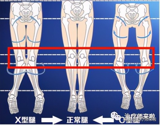 怎么让腿型改正,怎样使腿型变直
