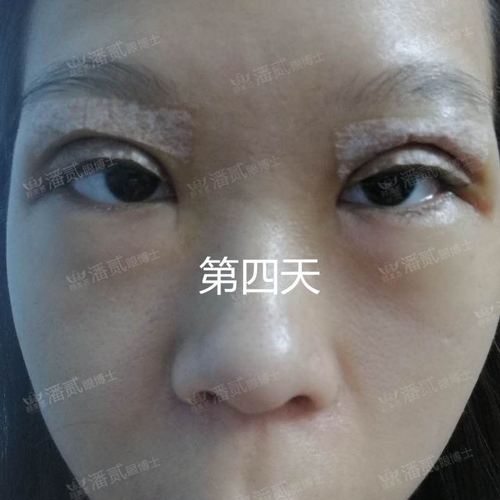 原来双眼皮不好看有必要继续割吗,割双眼皮是不是越修复越难看