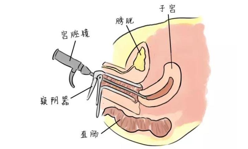 为什么一定要做腔内超声检查?