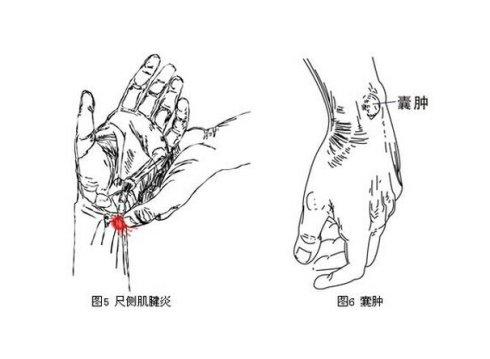 腱鞘炎手指解说图,腱鞘炎介绍