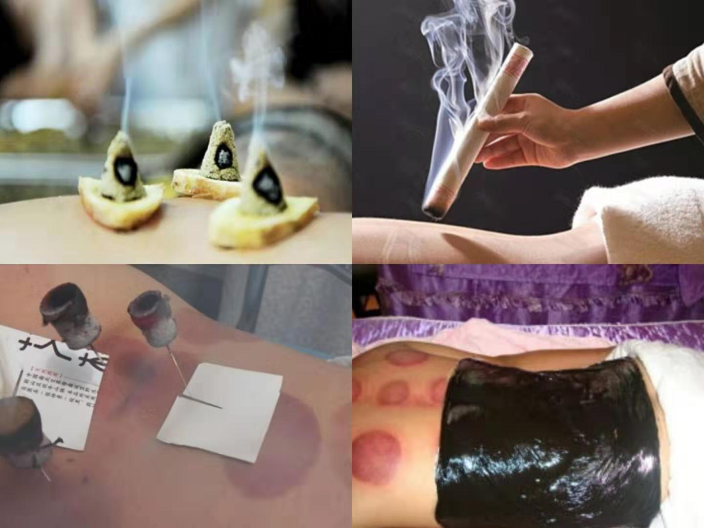 三伏贴理疗,康复医院三伏灸