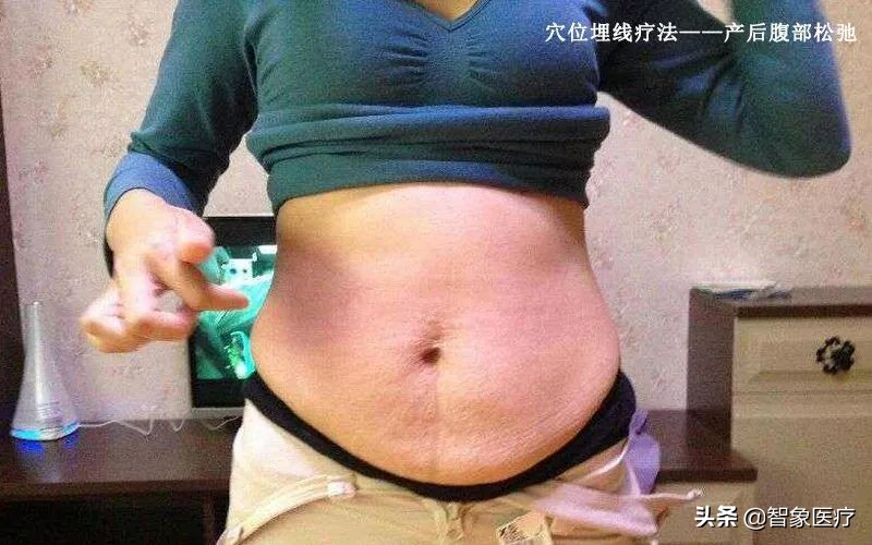产后腹部紧致按摩手法教程,产后修复穴位埋线