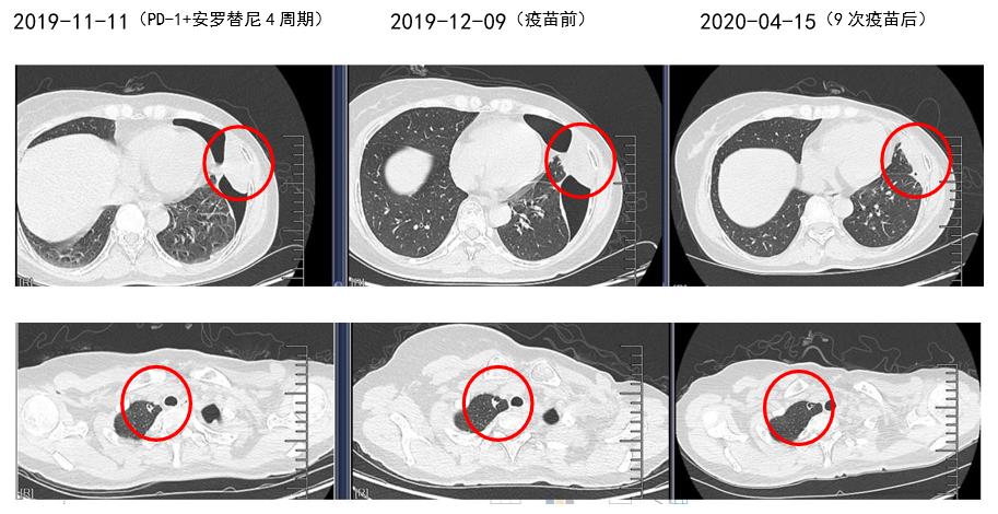 乳腺梭形细胞恶性肿瘤高级别,乳腺梭形细胞肉瘤