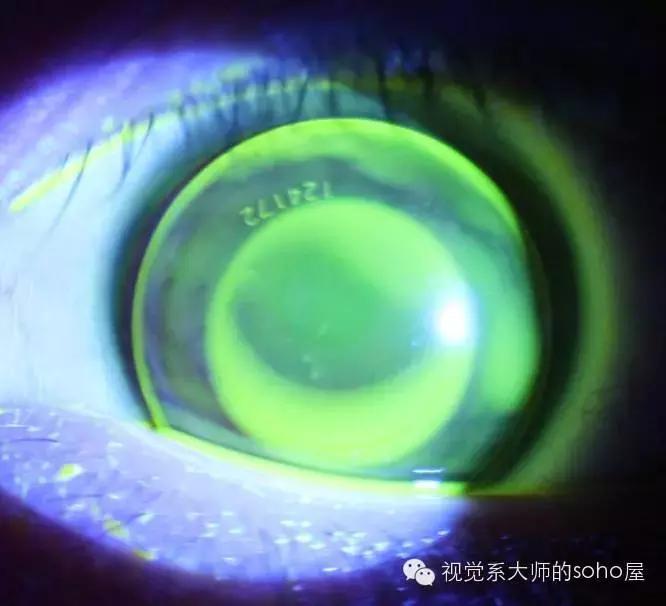 如何选择角膜塑形镜的品牌,怎么选角膜塑形镜的参数