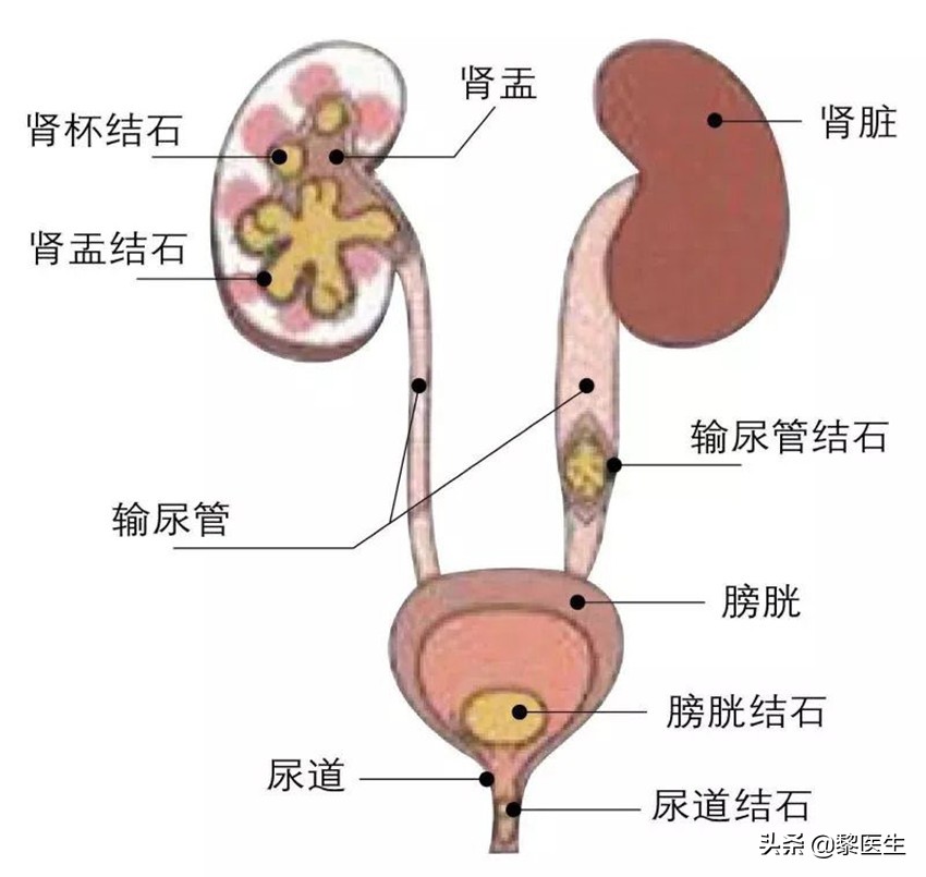 查出了肾结石不痛需要打掉吗,查出肾结石但是没有感觉