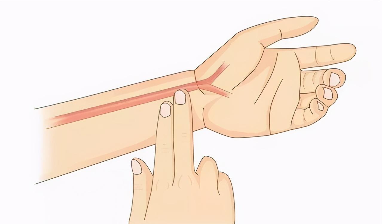 预激综合征射频消融术的护理,室上速射频消融术后如何护理