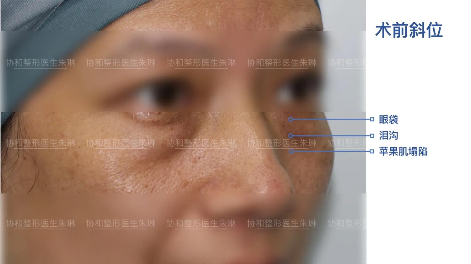 外切眼袋消肿食谱,外切眼袋20天效果图