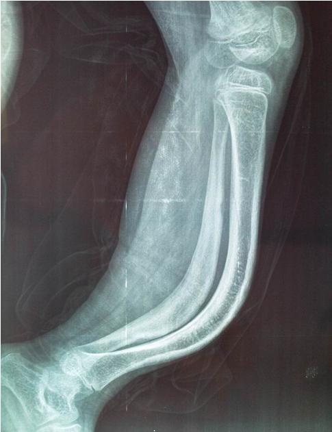 儿童手摔骨折了有哪些是要手术的,孩子骨折医生说要动手术